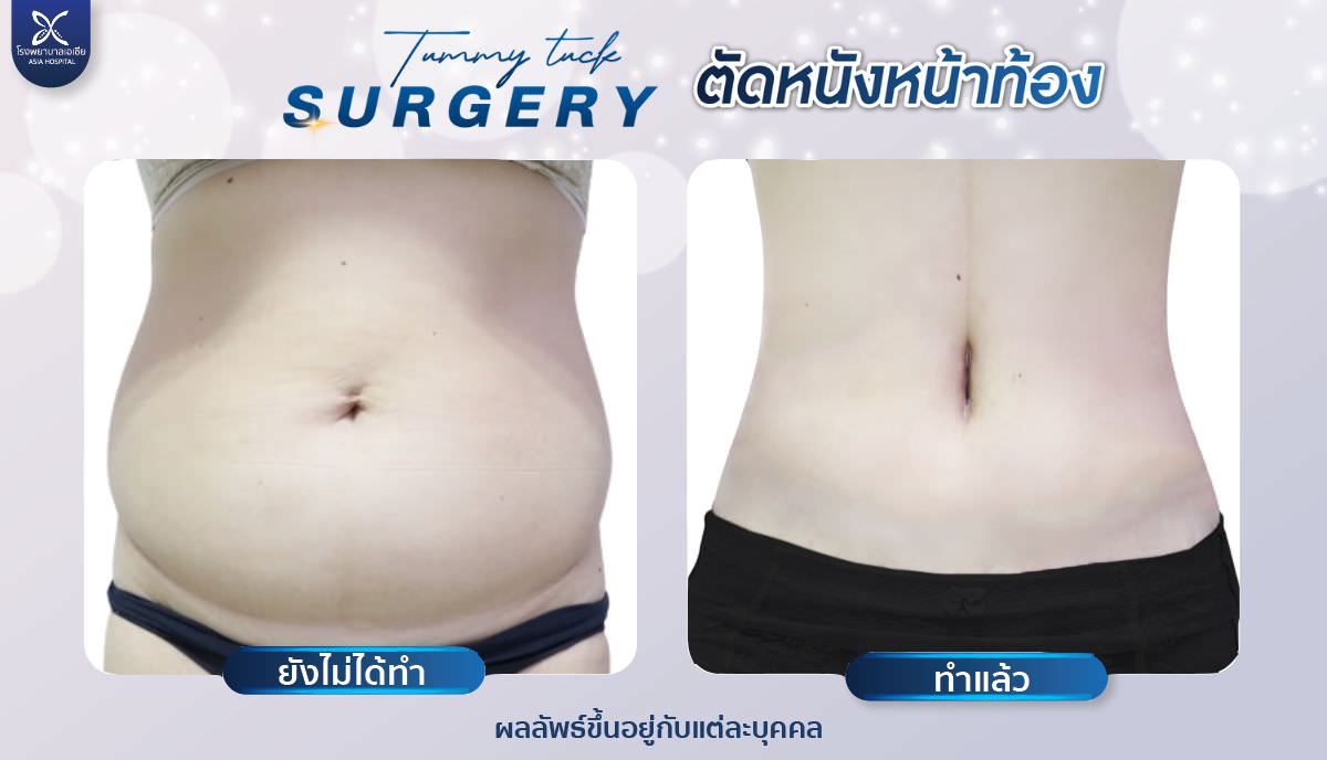 tummytuck-ตัดไขมันหน้าท้อง