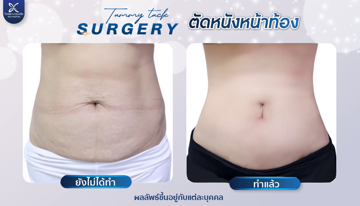 tummytuck-ศัลยกรรมตัดหนังหน้าท้อง