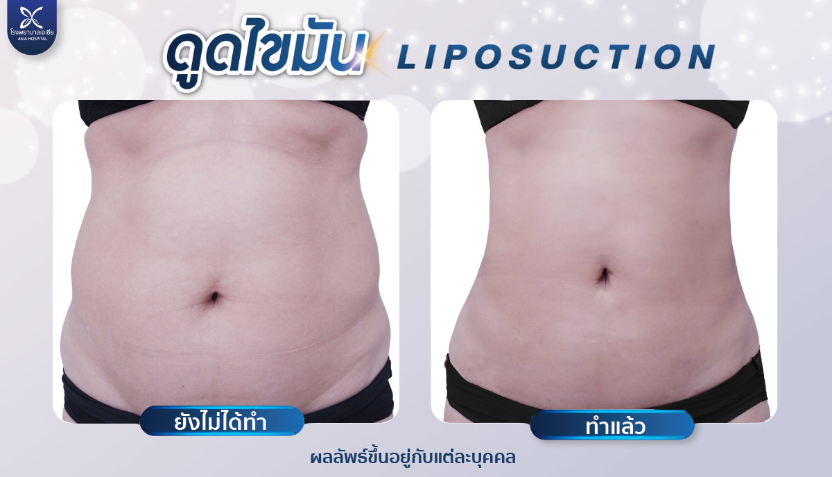 ดูดไขมัน-liposuction