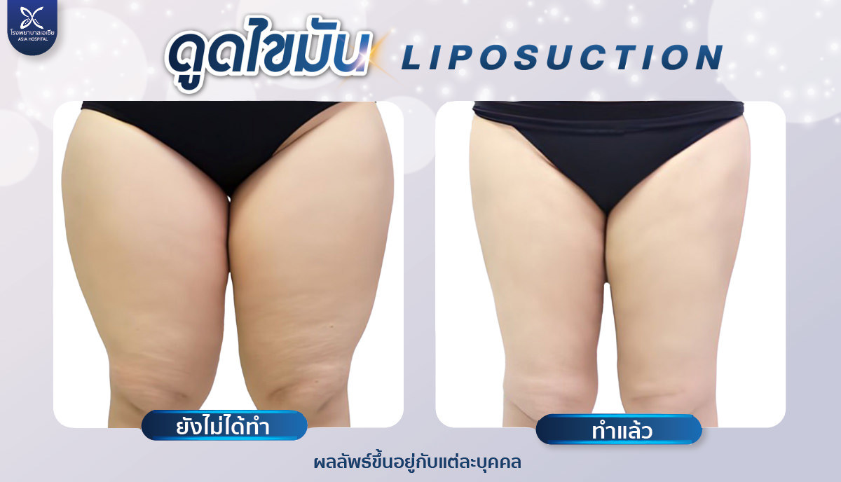 ดูดไขมัน-ดูดไขมันต้นขา-โรงพยาบาลเอเซีย