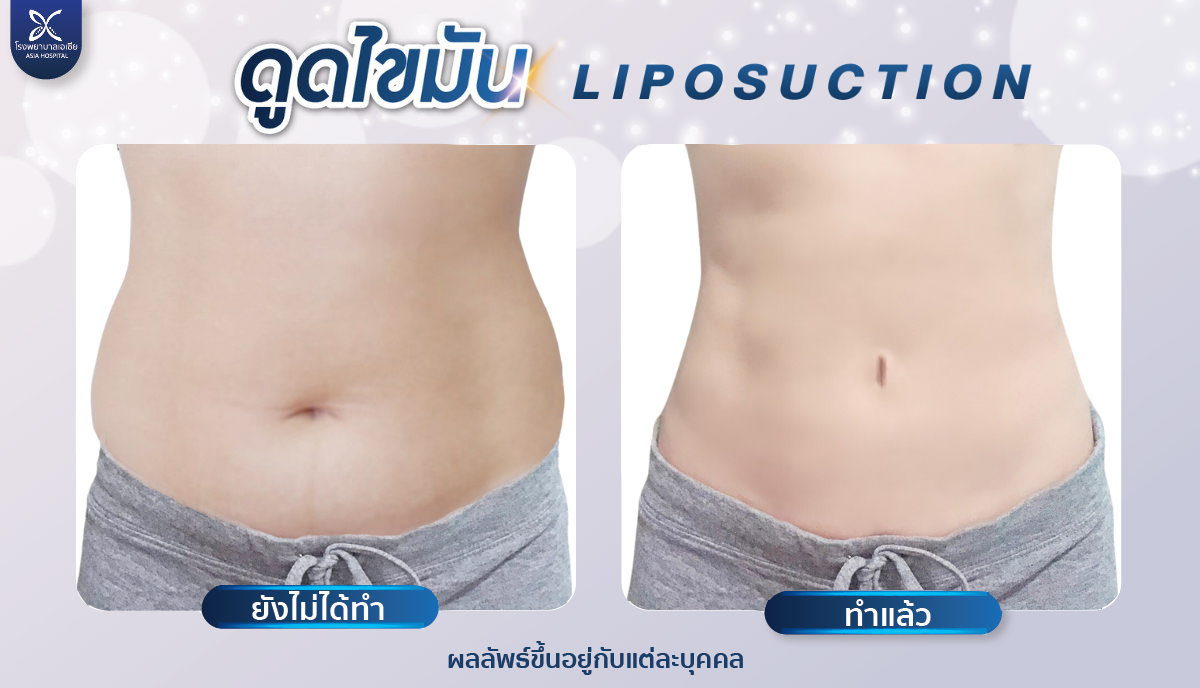ดูดไขมัน-โรงพยาบาลเอเซีย