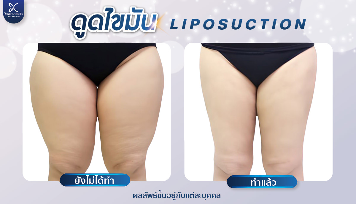 ดูดไขมันต้นขา-liposuction