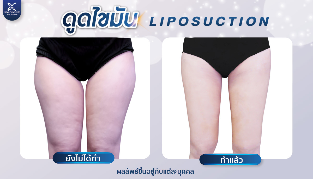 ดูดไขมันต้นขา-โรงพยาบาลเอเซีย-liposuction