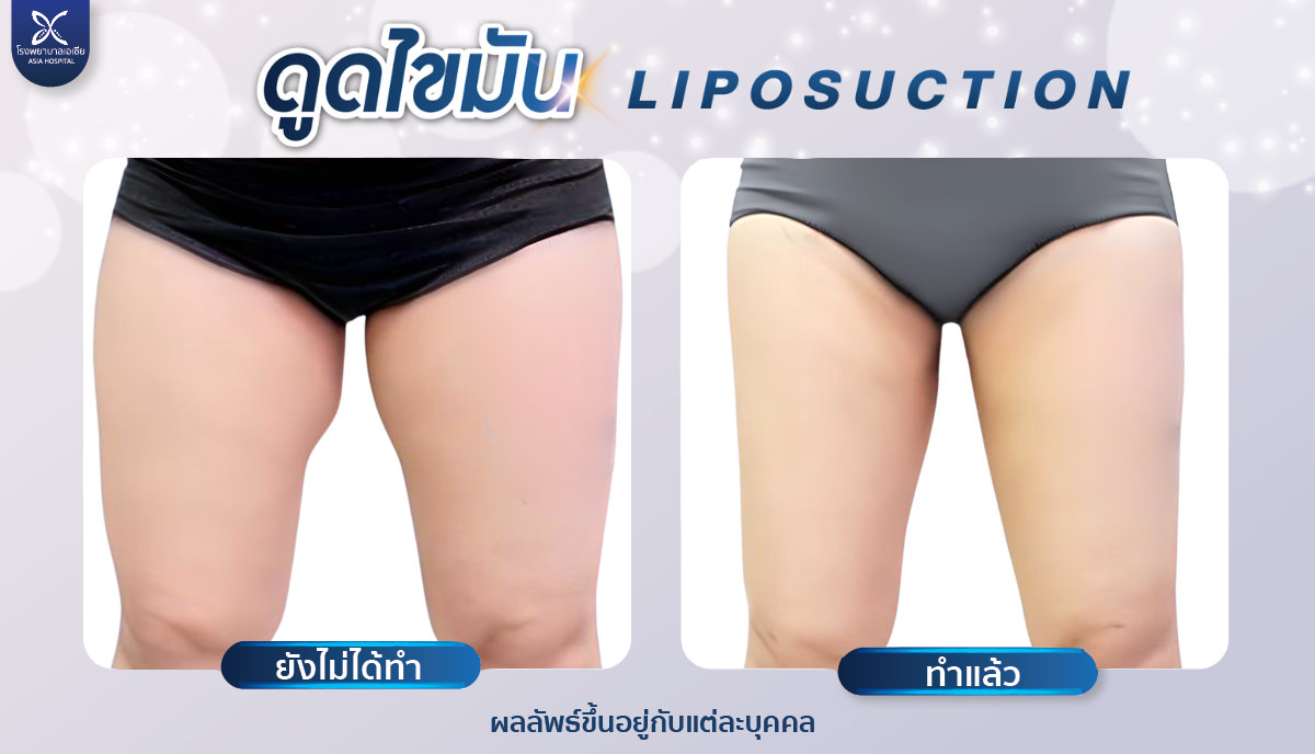 ดูดไขมันต้นขา