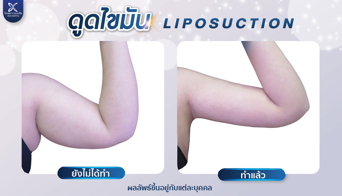 ดูดไขมันต้นแขน arm iposuction