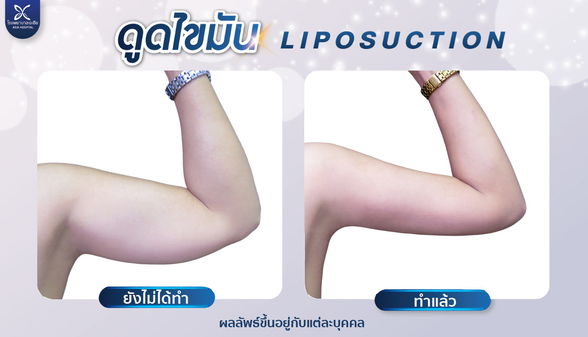 ดูดไขมันต้นแขน liposuction