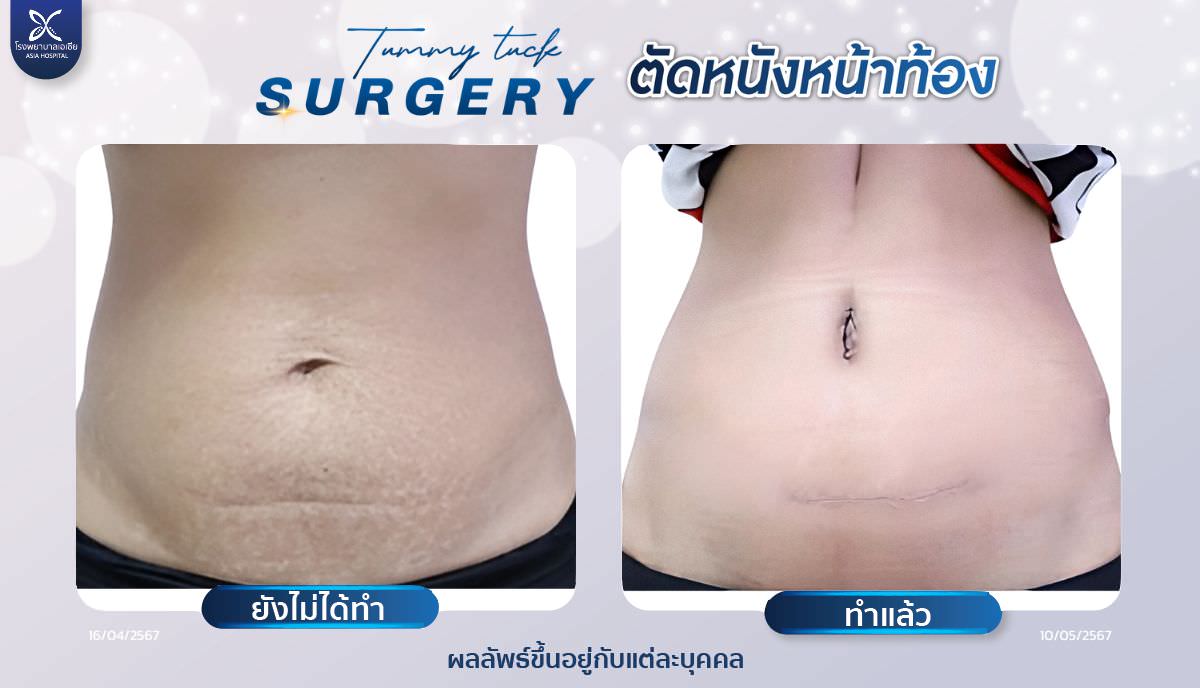 ตัดหนังหน้าท้อง-asiahospital