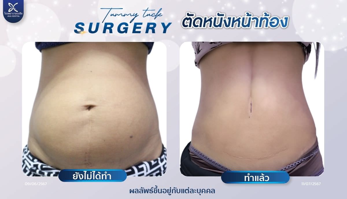ตัดหนังหน้าท้อง-tummytuck