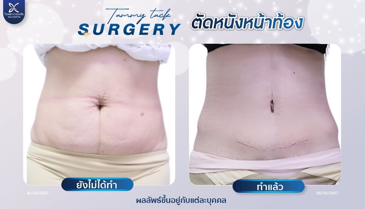 ตัดหนังหน้าท้อง-ตัดไขมันหน้าท้อง