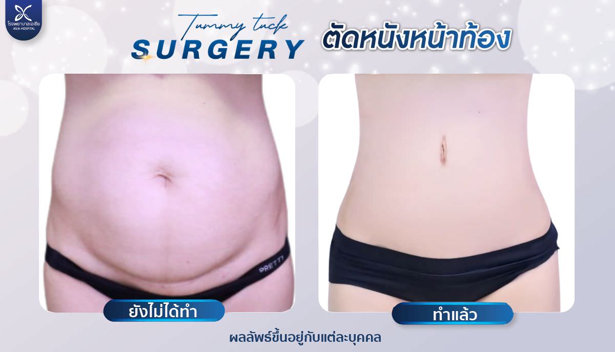 ตัดหนังหน้าท้อง-ยกกระชับหน้าท้อง