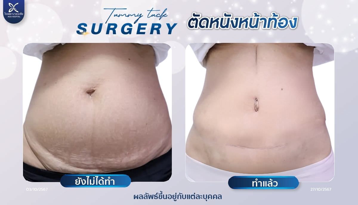 ตัดหนังหน้าท้อง-โรงพยาบาลเอเซีย