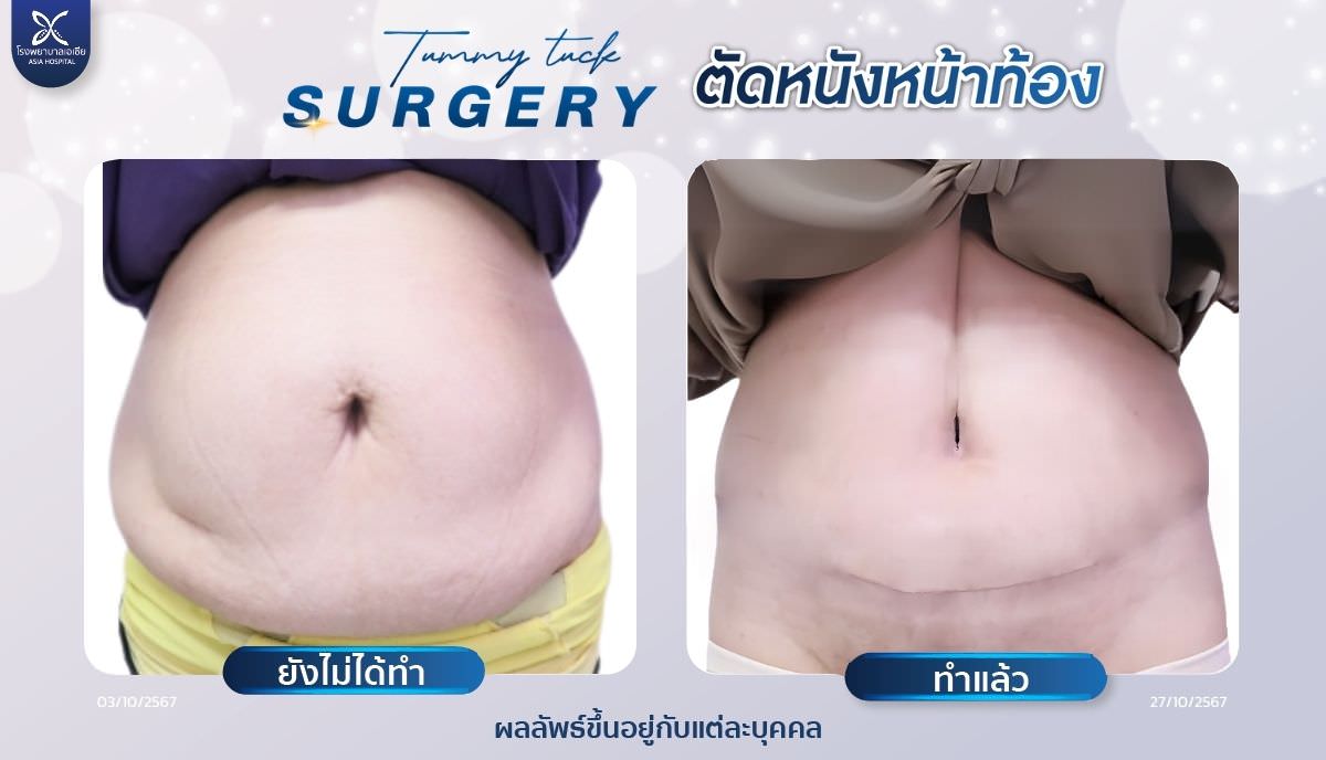 ตัดหนังหน้าท้อง