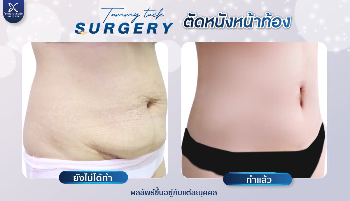 ตัดไขมัน-ยกกระชับหน้าท้อง