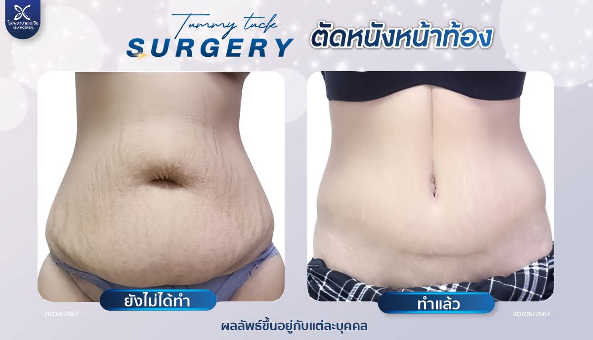 ตัดไขมันหน้าท้อง-tummytuck
