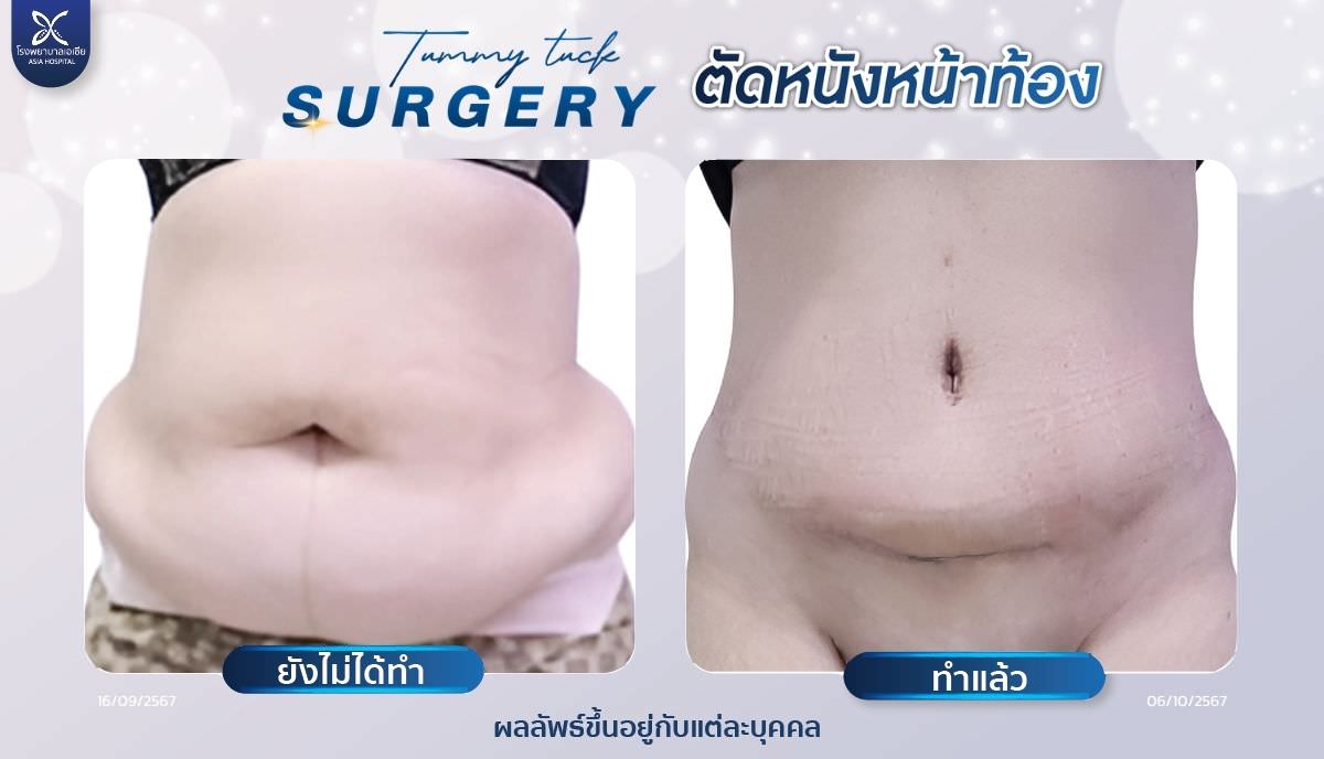 ตัดไขมันหน้าท้อง-โรงพยาบาลเอเซีย