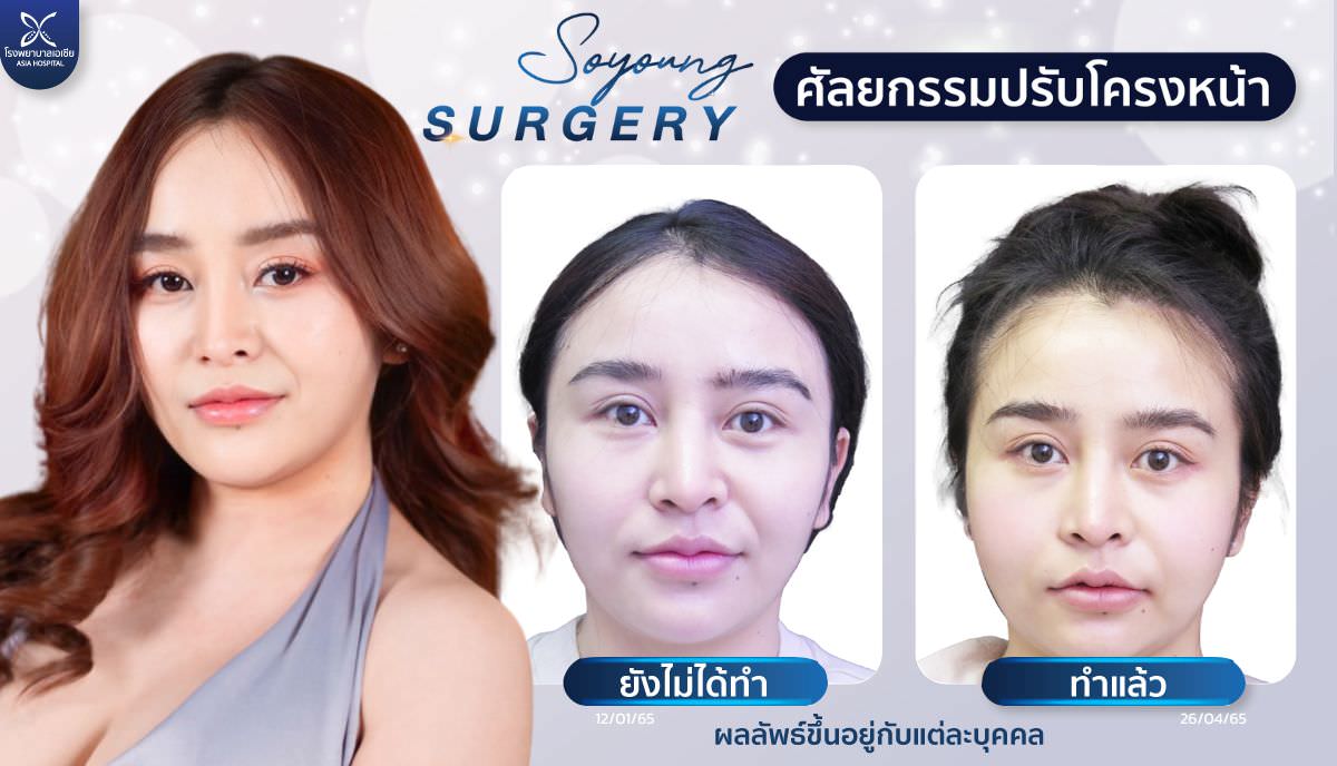 ปรับโครงหน้า_ตัดกราม