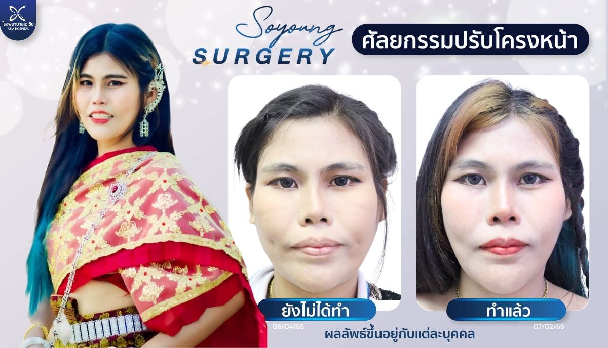 ปรับโครงหน้า_รีวิวตัดกราม