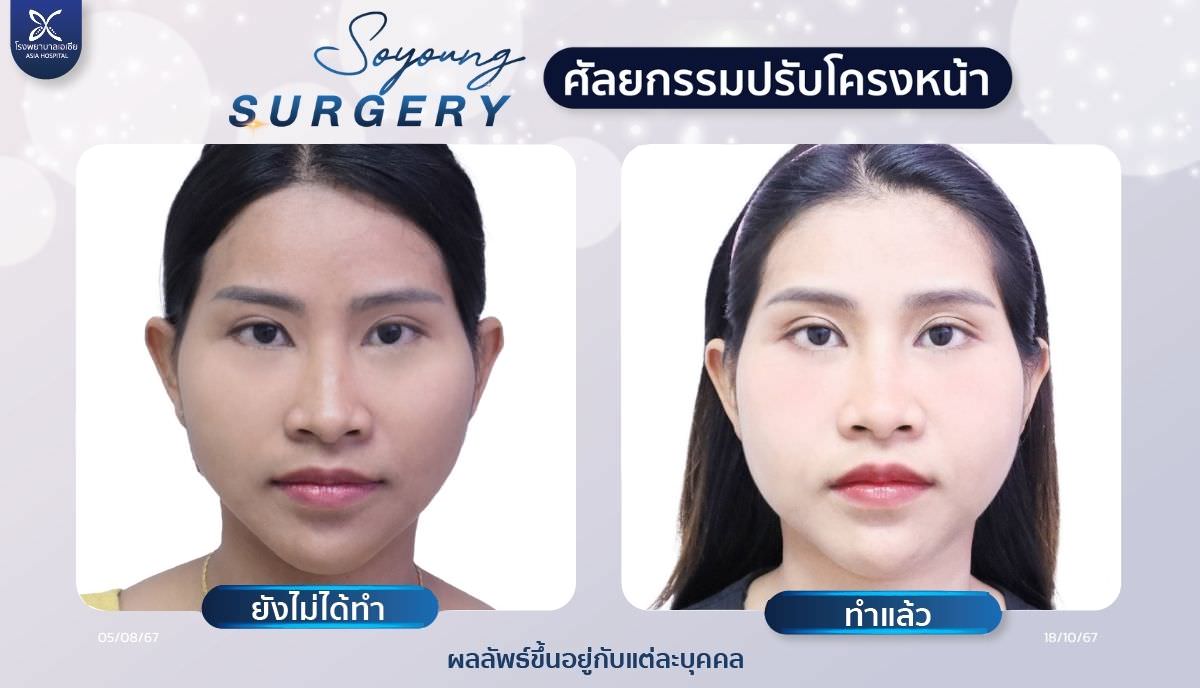 รีวิวตัดกราม_โรงพยาบาลเอเซีย
