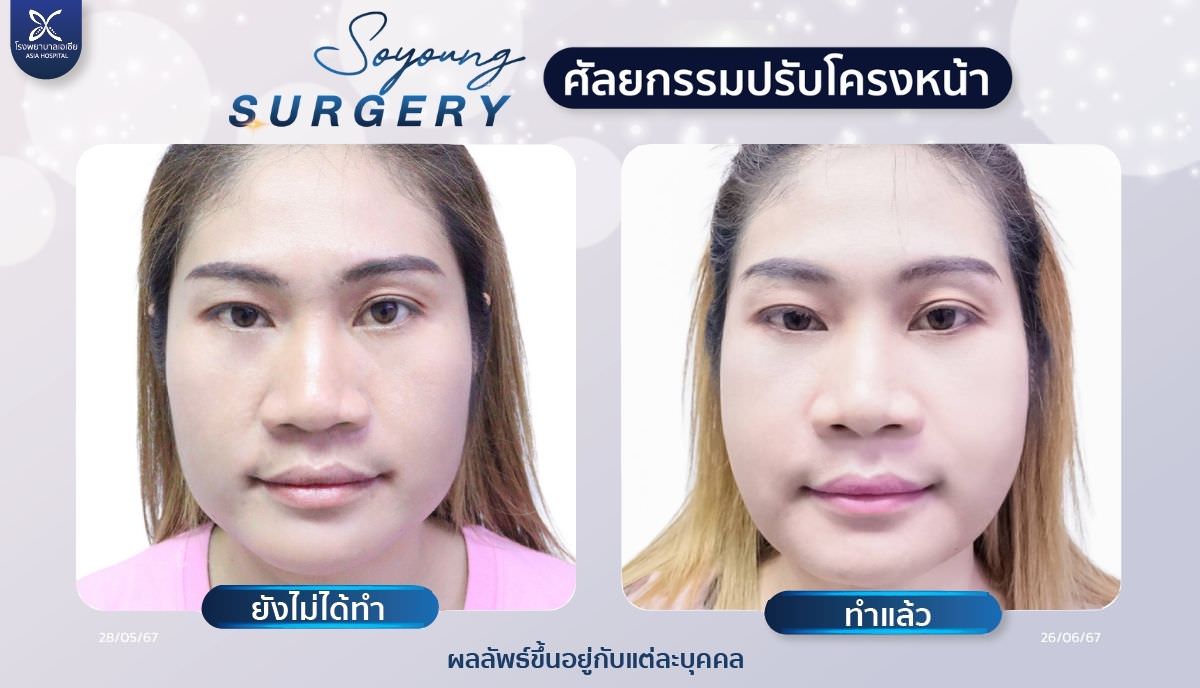 ปรับโครงหน้า_รีวิวตัดกราม_โรงพยาบาลเอเซีย