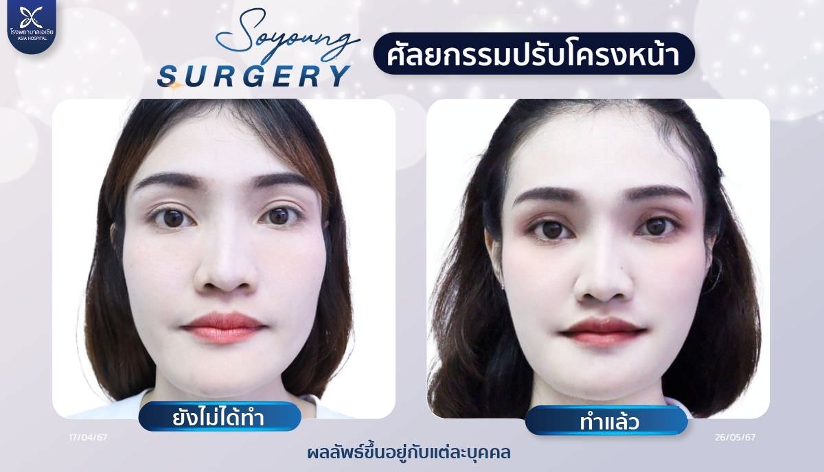 ปรับโครงหน้า_รีวิวตัดกราม_โรงพยาบาลเอเซีย