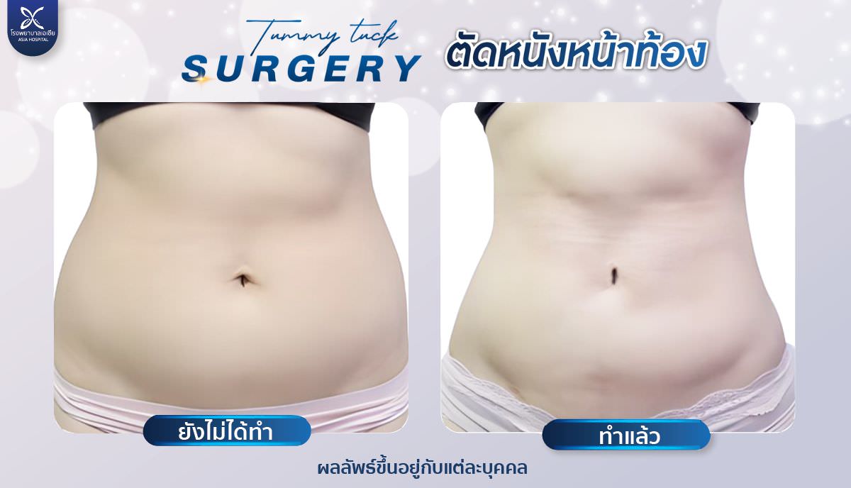 ผ่าตัดหนังหน้าท้อง-ตัดไขมันหน้าท้อง