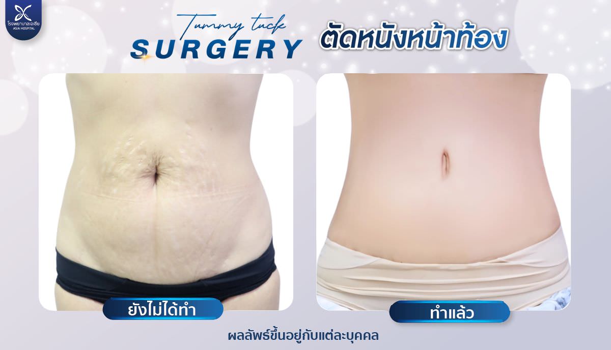 ผ่าตัดหนังหน้าท้อง-โรงพยาบาลเอเซีย