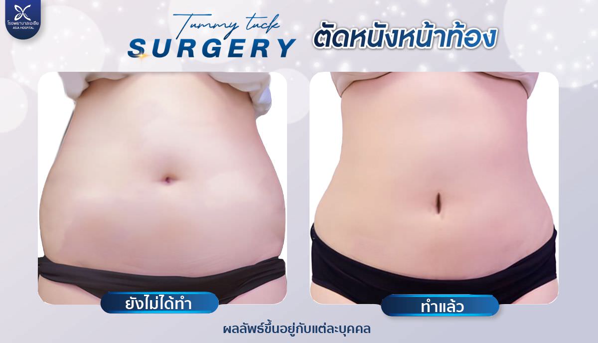 ผ่าตัดหนังหน้าท้อง