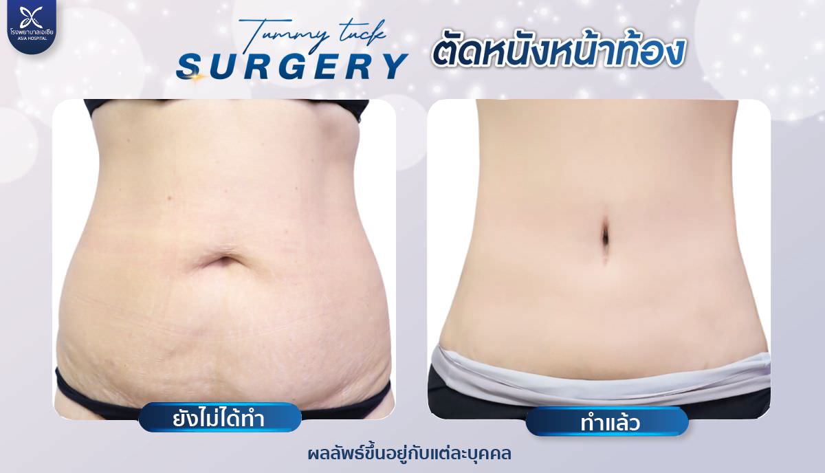 ยกกระชับหน้าท้อง-ตัดหน้าท้อง
