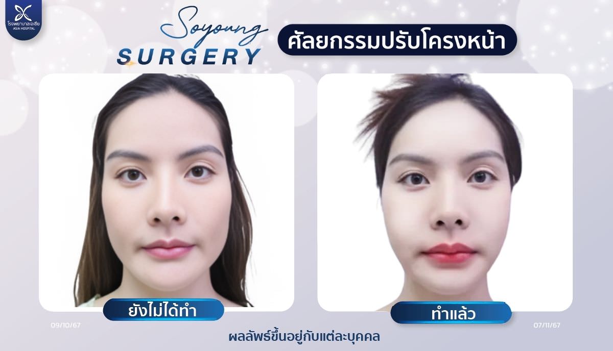 ยุบโหนก_ตัดกราม_วีไลน์