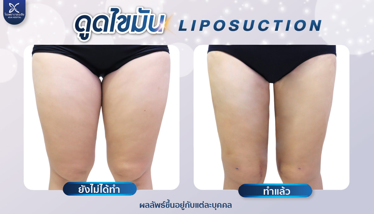 รีวิวดูดไขมัน-ดูดไขมันต้นขา