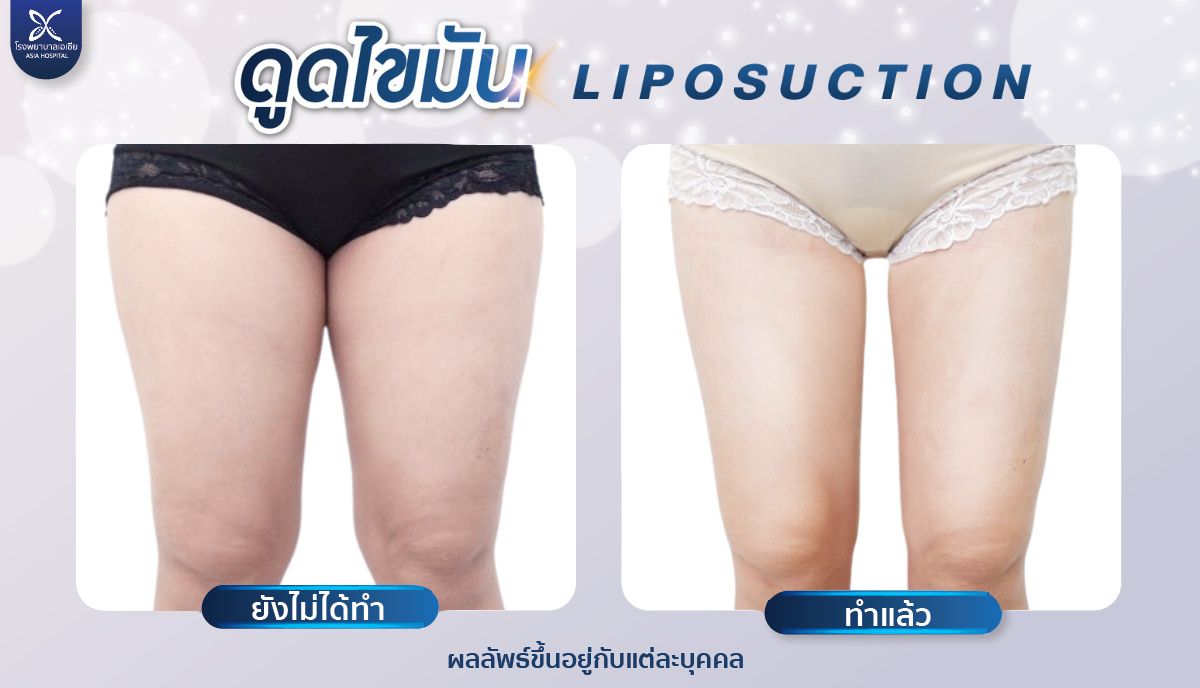 รีวิวดูดไขมันต้นขา-โรงพยาบาลเอเซีย