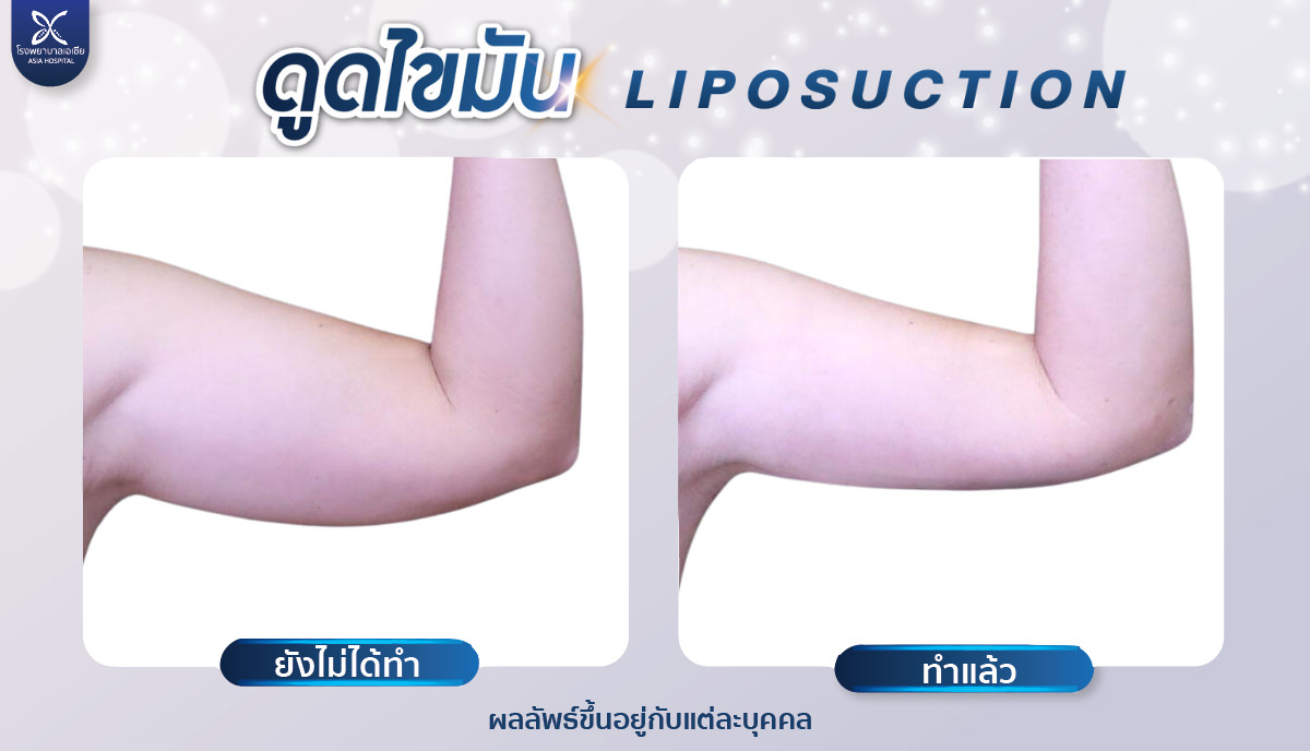 รีวิวดูดไขมันต้นแขน โรงพยาบาลเอเซีย