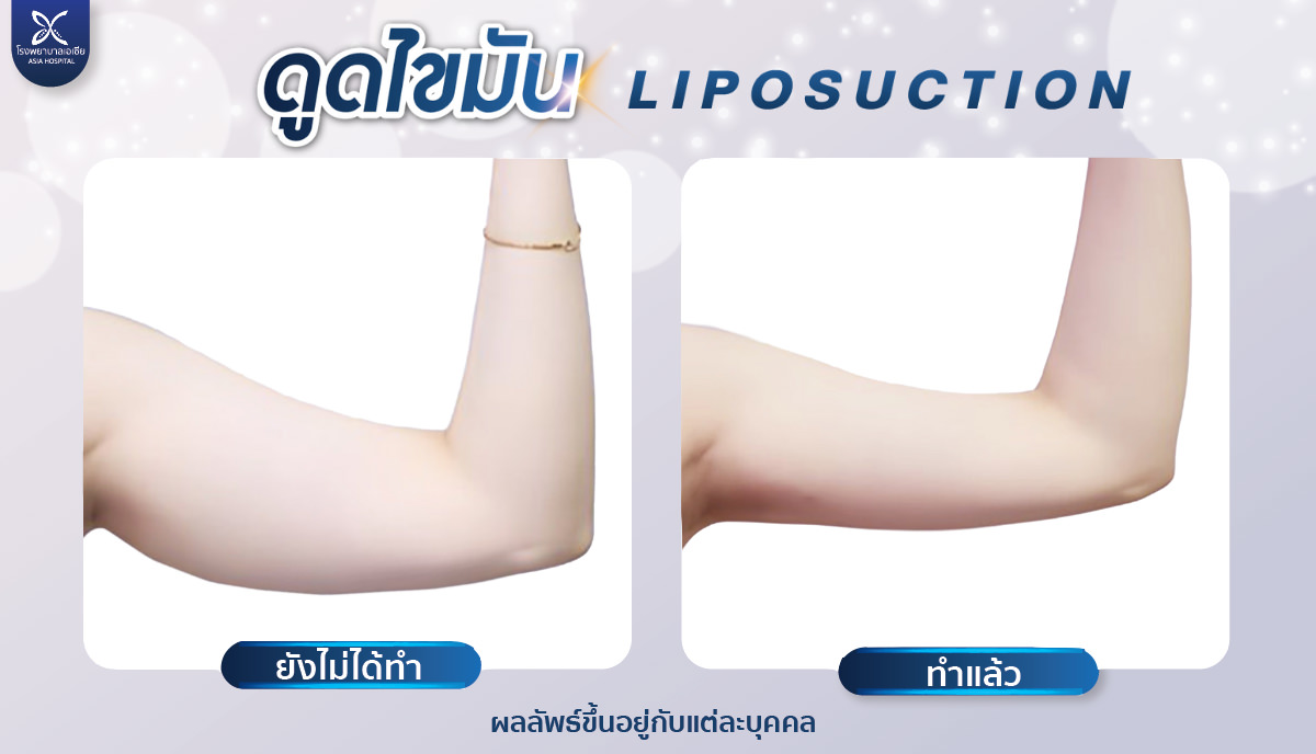 รีวิวดูดไขมันต้นแขน