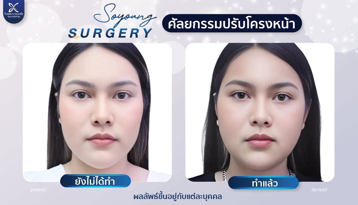 รีวิวตัดกราม_กรอกราม_ถอดซิลิโคนคาง__โรงพยาบาลเอเซีย