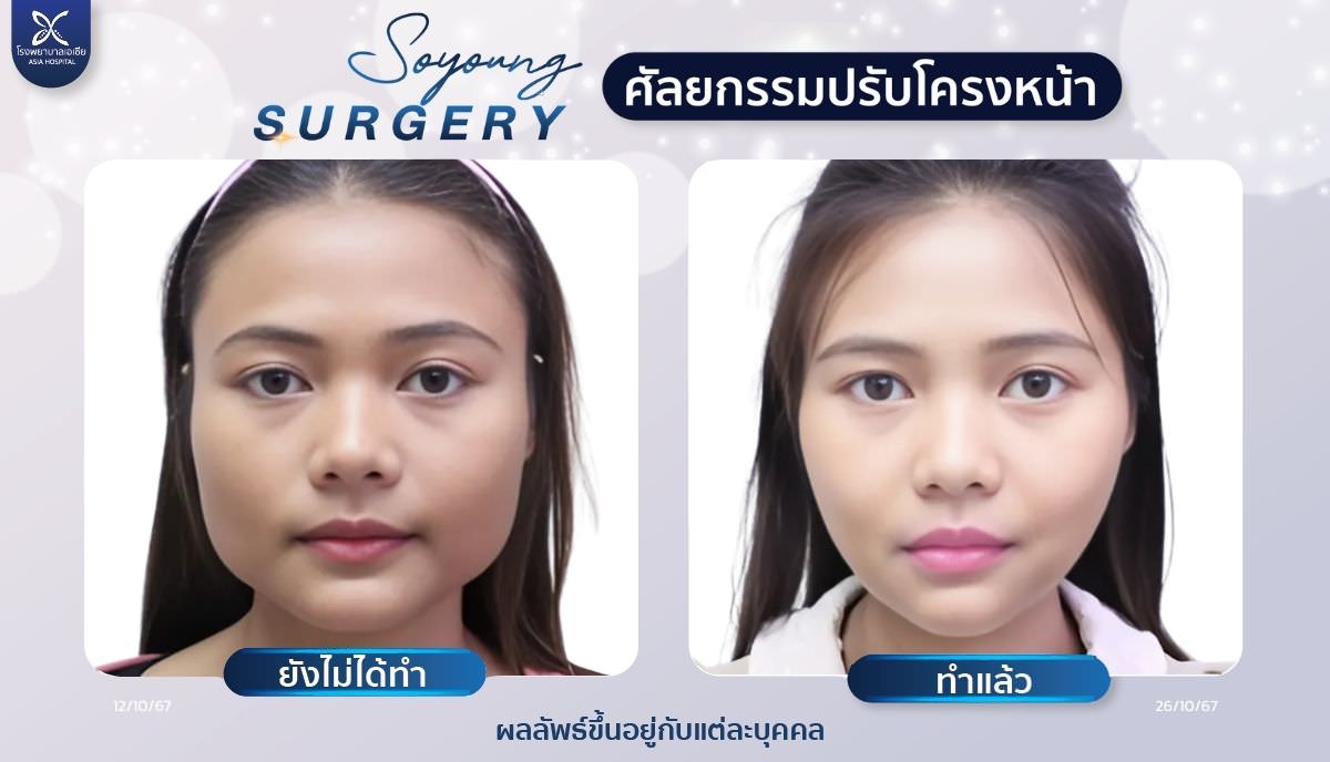 รีวิวตัดกราม_กรอกราม_โรงพยาบาลเอเซีย