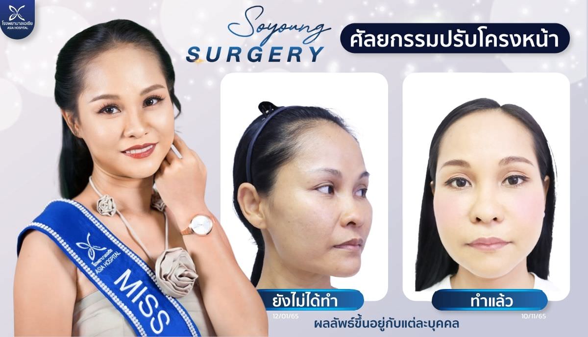รีวิวตัดกราม_เหลากราม