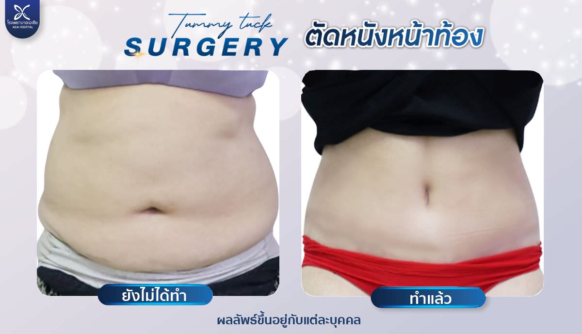 รีวิวตัดหนังหน้าท้อง-โรงพยาบาลเอเซีย