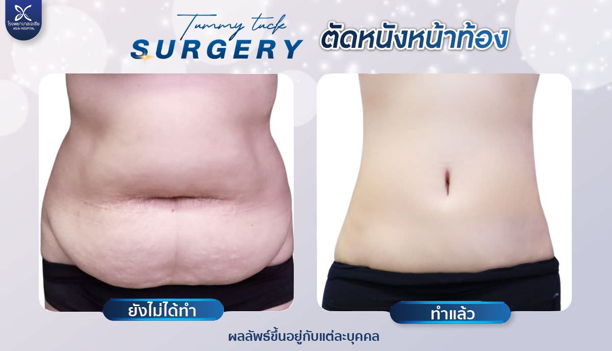 รีวิวตัดหนังหน้าท้อง