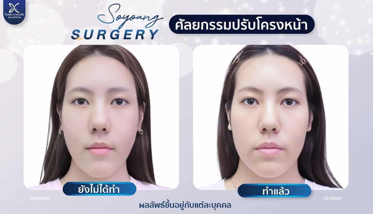 รีวิวทุบโหนกแก้ม_ลดโหนกแก้ม_โรงพยาบาลเอเซีย