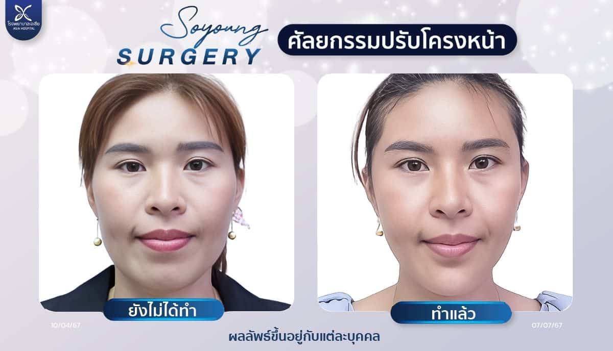 รีวิวทุบโหนกแก้ม_ลดโหนกแก้ม_โรงพยาบาลเอเซีย