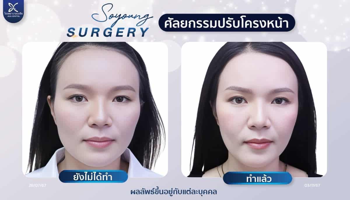 รีวิวทุบโหนกแก้ม_ลดโหนกแก้ม_โรงพยาบาลเอเซีย