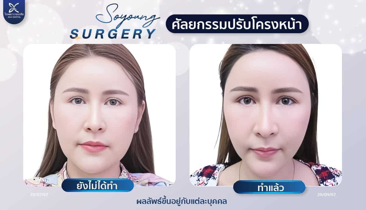 รีวิวทุบโหนกแก้ม_ลดโหนกแก้ม_โรงพยาบาลเอเซีย
