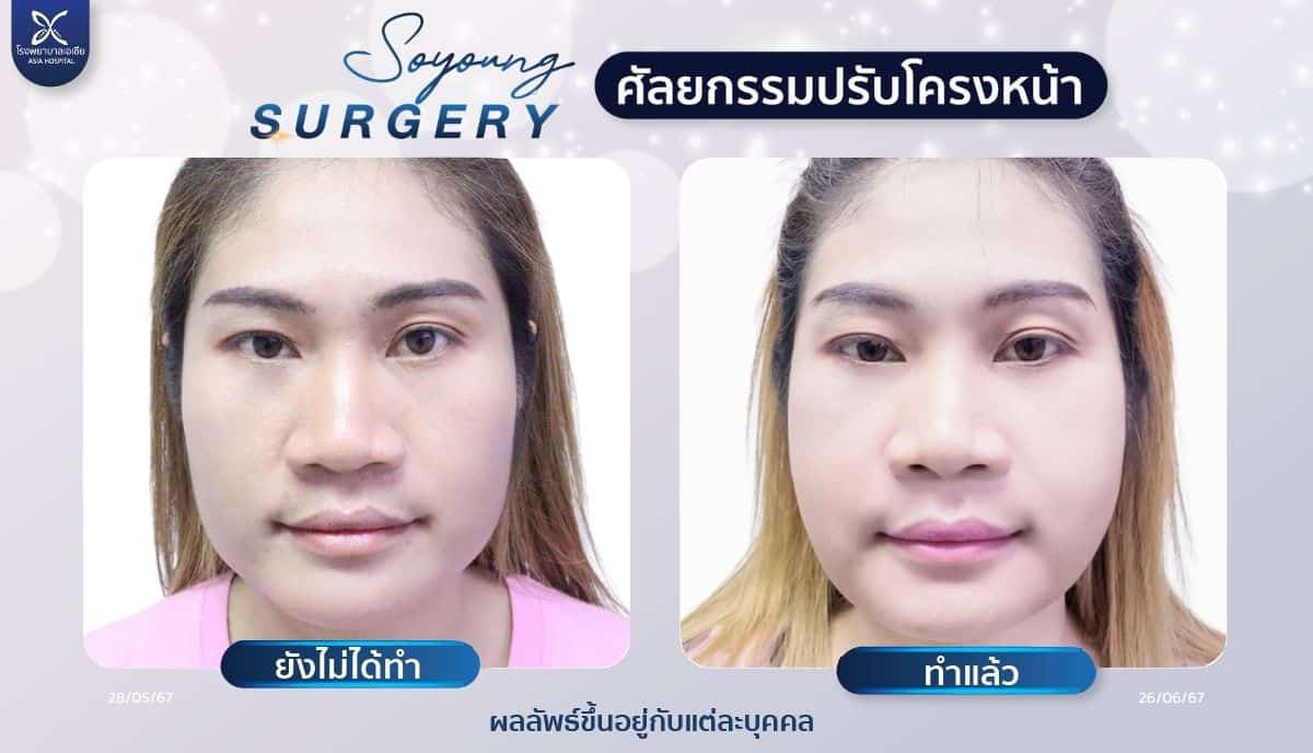 รีวิวทุบโหนกแก้ม_ลดโหนกแก้ม_โรงพยาบาลเอเซีย