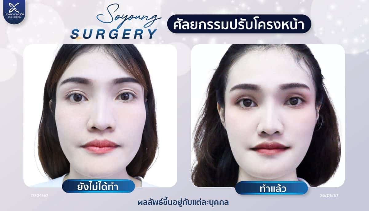 รีวิวทุบโหนกแก้ม_ลดโหนกแก้ม_โรงพยาบาลเอเซีย