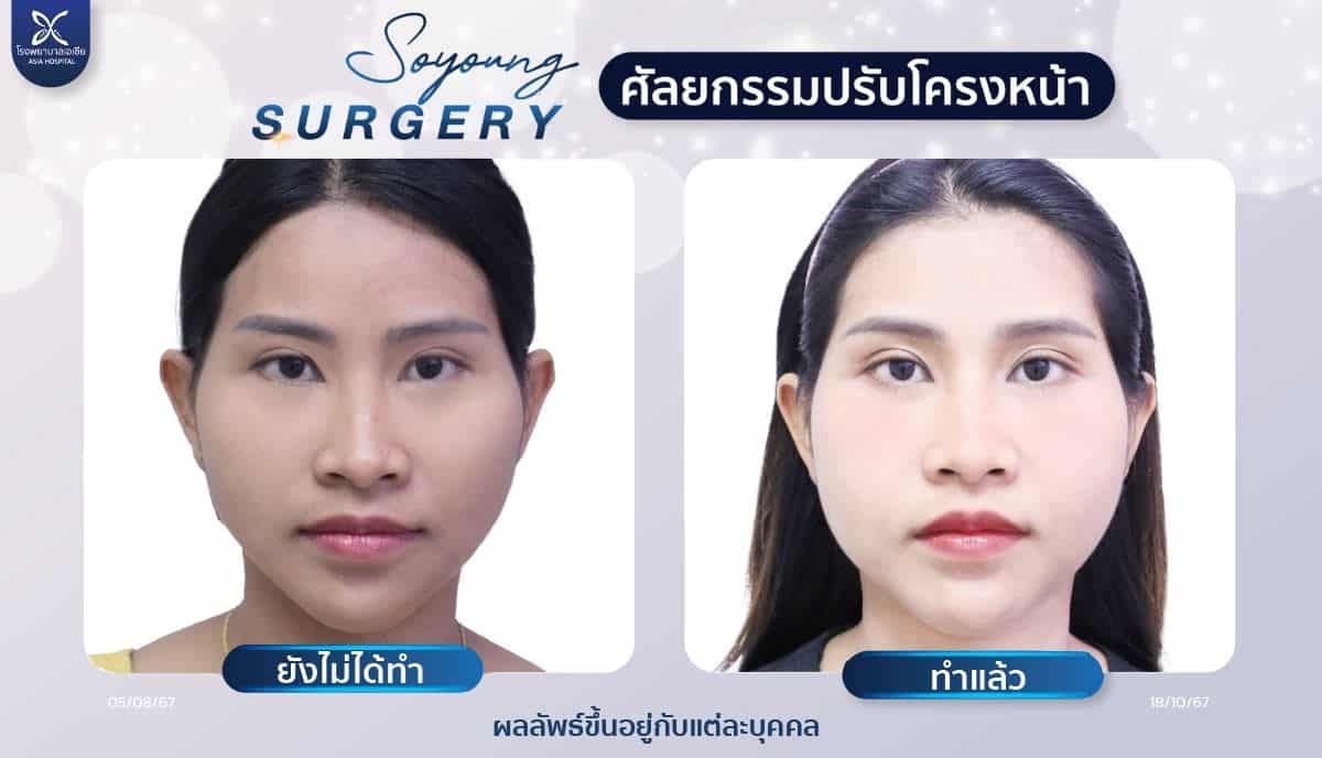 รีวิวทุบโหนกแก้ม_ลดโหนกแก้ม_โรงพยาบาลเอเซีย