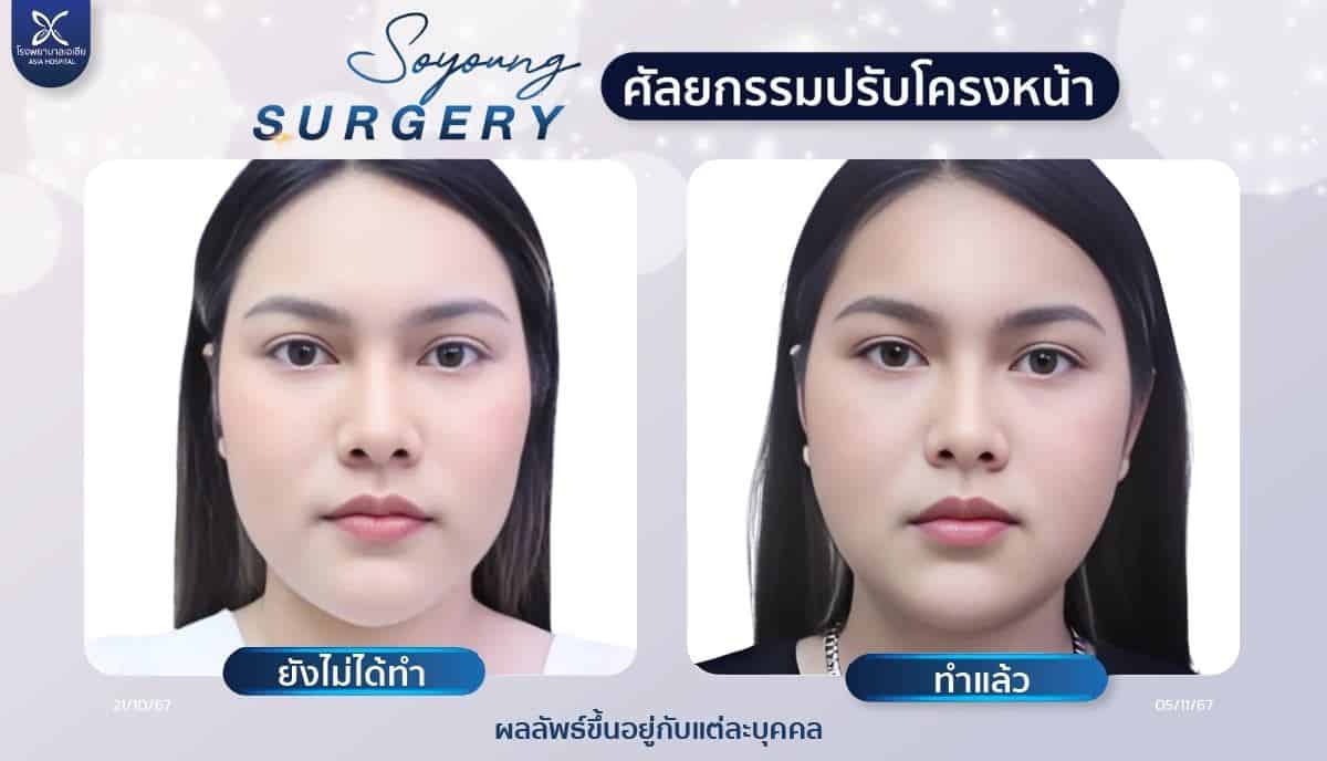 รีวิวยุบโหนกแก้ม_ตัดกราม_ถอดซิลิโคนคาง
