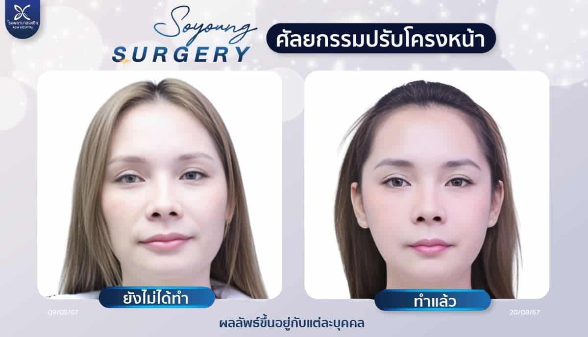 รีวิวยุบโหนกแก้ม_ตัดกราม_ปรับโครงหน้า