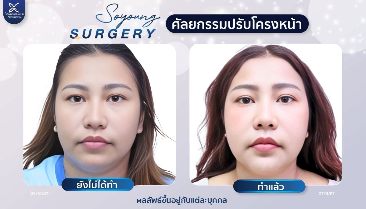 รีวิวลดโหนกแก้ม_ยุบโหนกแก้ม