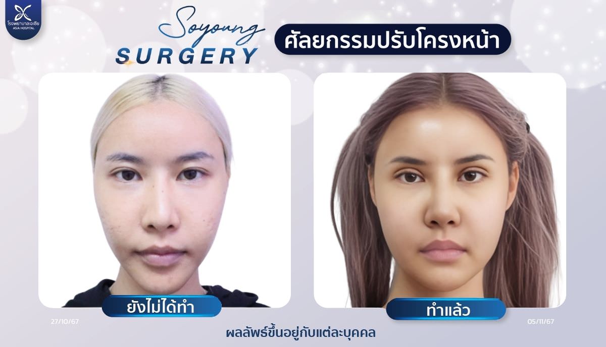 วีไลน์_V-Line_หน้าเรียว_โรงพยาบาลเอเซีย
