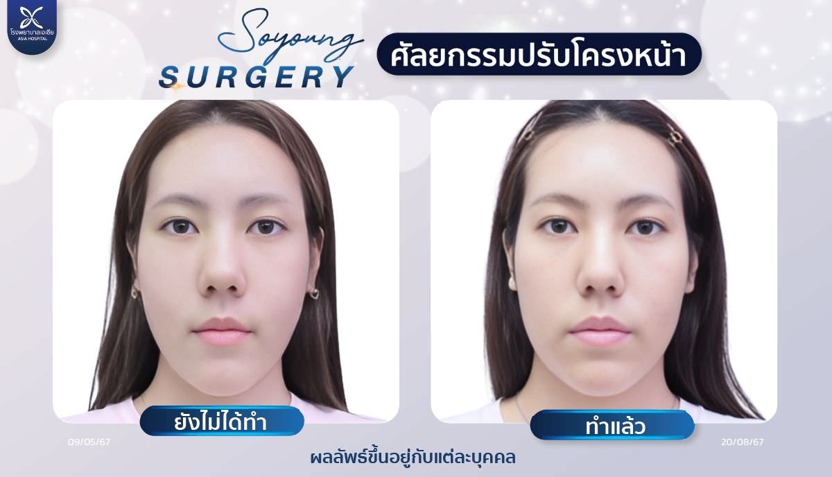 วีไลน์_V-Line_หน้าเรียว_โรงพยาบาลเอเซีย